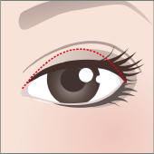 眼まぶた下垂（MT法)